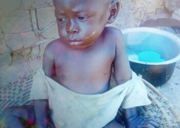 Tshopo : recrudescence des cas de malnutrition dans le territoire de Basoko, les structures sanitaires tirent la sonnette d’alarme